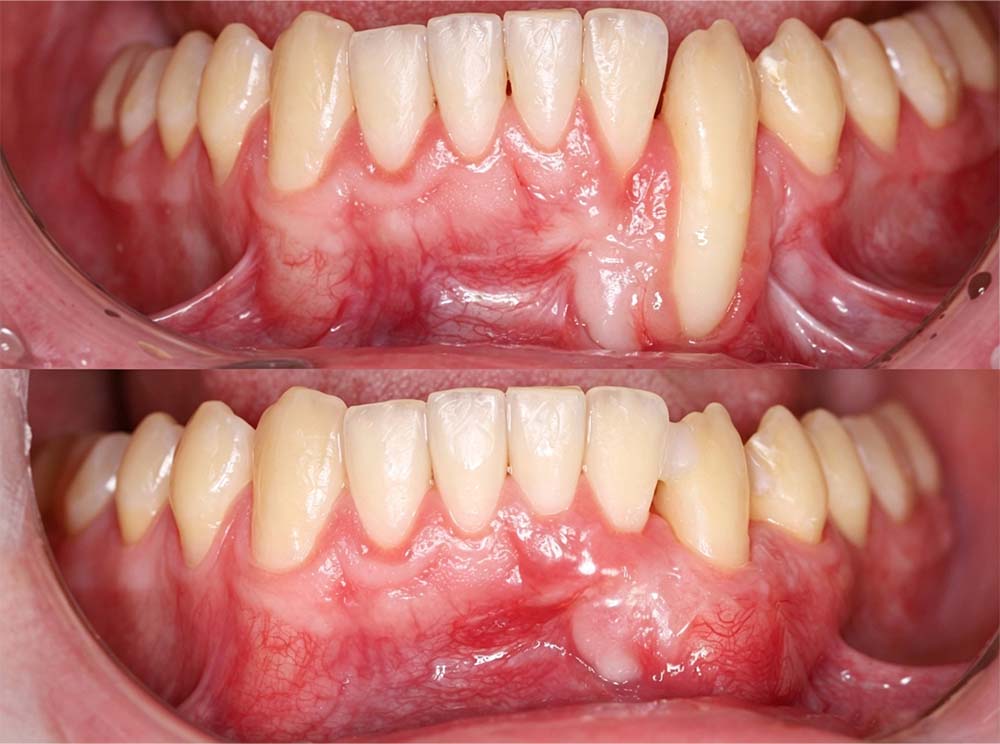 💎Purelora® GumRevive Periodontal Repair Gel