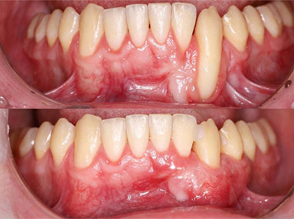 💎Purelora® GumRevive Periodontal Repair Gel