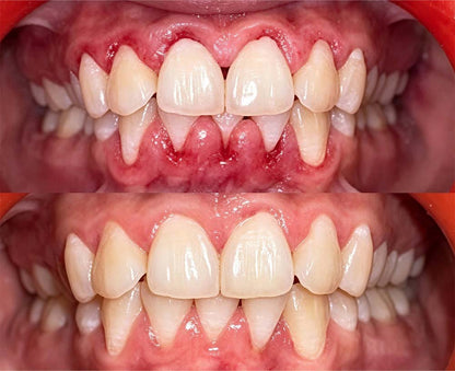 💎Purelora® GumRevive Periodontal Repair Gel