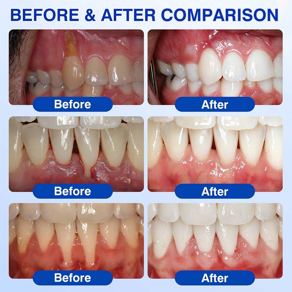💎Purelora® GumRevive Periodontal Repair Gel
