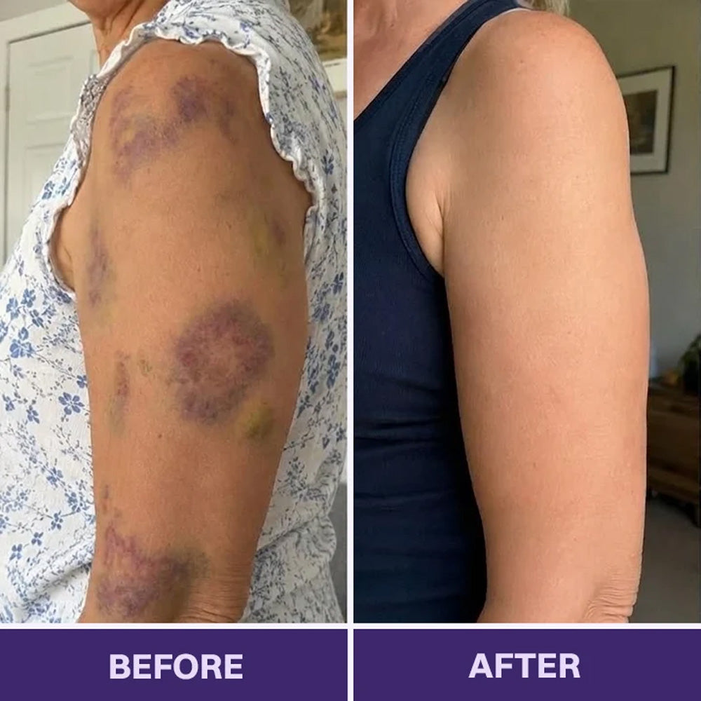 Purelora® Bruise Repair & Skin-Strengthening Cream